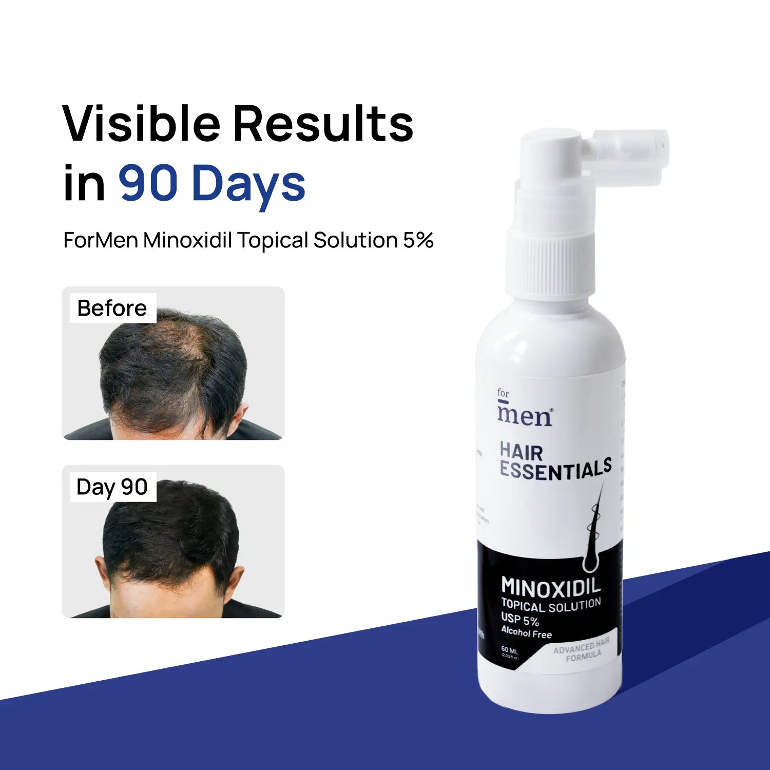 Minoxidil Topical Solution 5% (60ml)